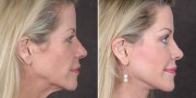 Dr. Kao Ponytail Facelift