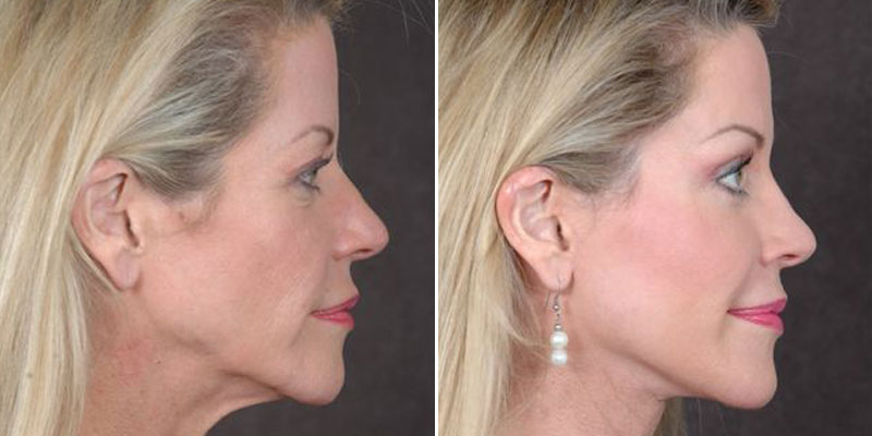 Dr. Kao Ponytail Facelift