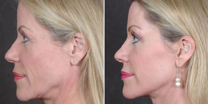 Dr. Kao Ponytail Facelift