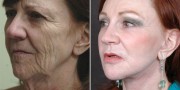 Dr. Kao Ponytail Facelift