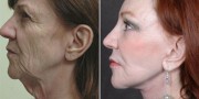 Dr. Kao Ponytail Facelift