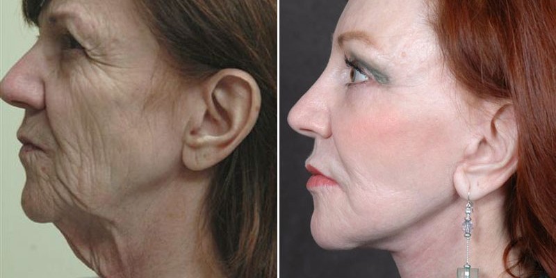 Dr. Kao Ponytail Facelift