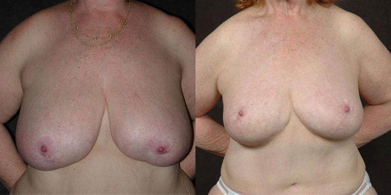 Dr. Kao Breast Reduction