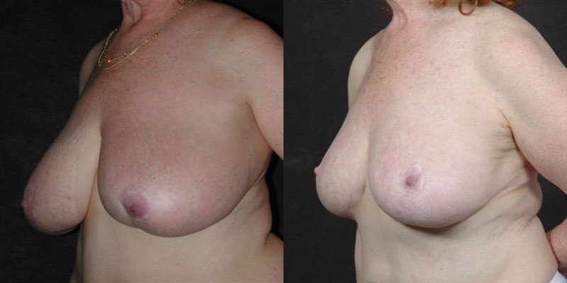 Dr. Kao Breast Reduction