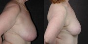 Dr. Kao Breast Reduction