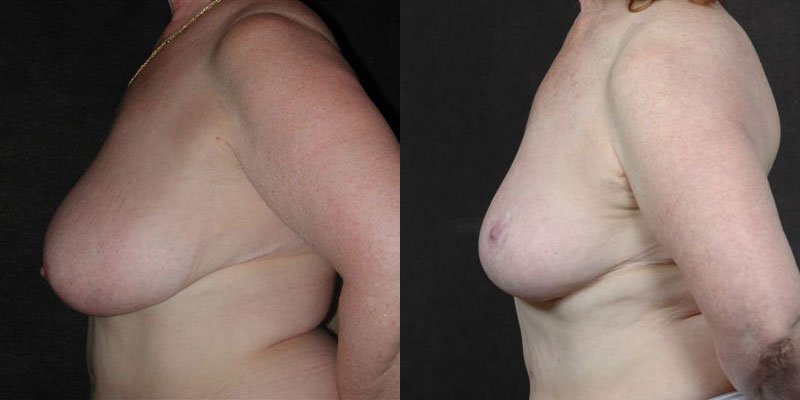 Dr. Kao Breast Reduction