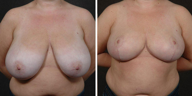 Dr. Kao Breast Reduction