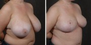 Dr. Kao Breast Reduction