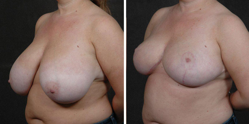 Dr. Kao Breast Reduction