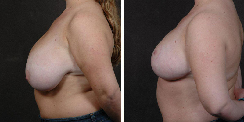 Dr. Kao Breast Reduction