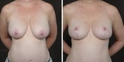 Dr. Kao Breast Reduction