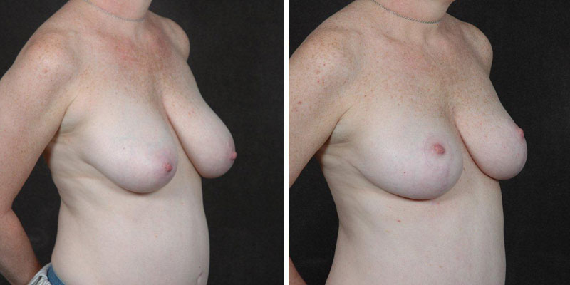 Dr. Kao Breast Reduction