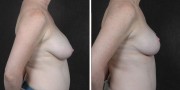 Dr. Kao Breast Reduction