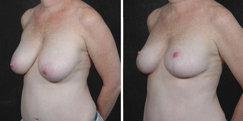 Dr. Kao Breast Reduction