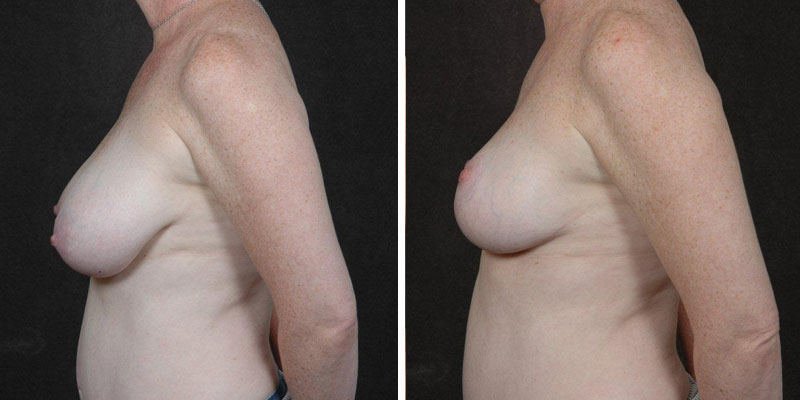 Dr. Kao Breast Reduction