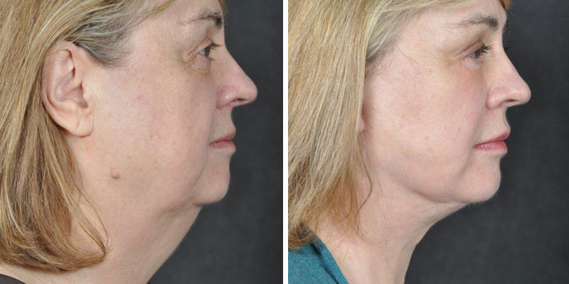 Dr. Kao Ponytail Facelift