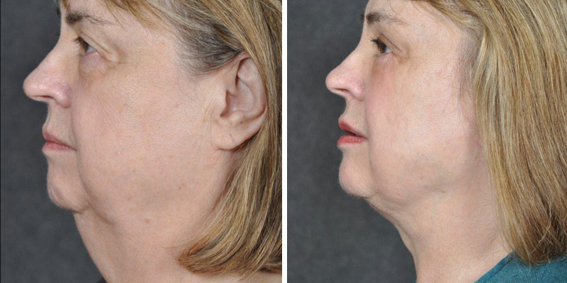 Dr. Kao Ponytail Facelift