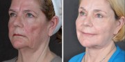 Dr. Kao Ponytail Facelift