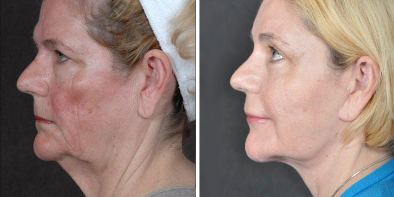 Dr. Kao Ponytail Facelift