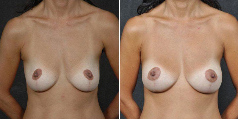 Dr. Kao Breast Augmentation