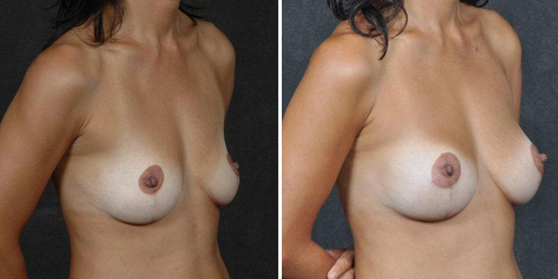 Dr. Kao Breast Augmentation