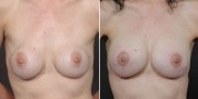 Dr. Kao Breast Implant Revision