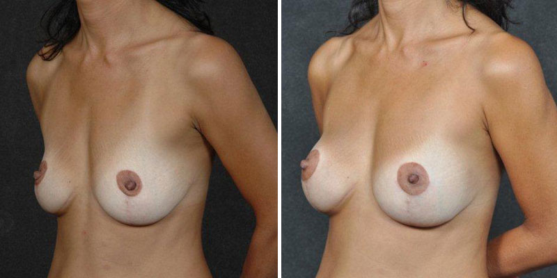 Dr. Kao Breast Augmentation