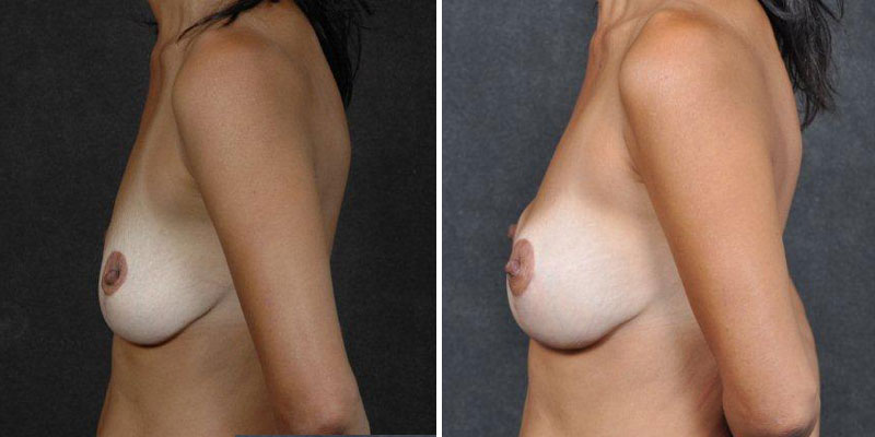 Dr. Kao Breast Augmentation