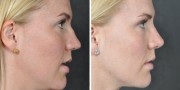 Dr. Kao Rhinoplasty