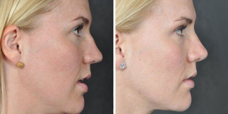 Dr. Kao Rhinoplasty