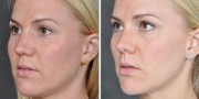 Dr. Kao Rhinoplasty