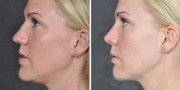 Dr. Kao Rhinoplasty