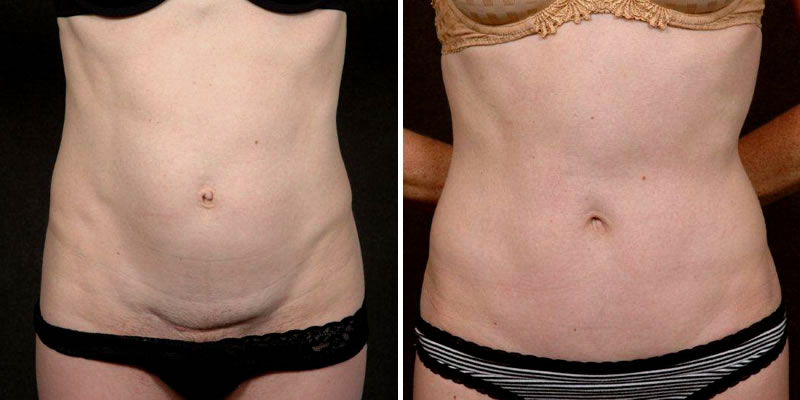 Dr. Kao Tummy Tuck (Abdominoplasty)