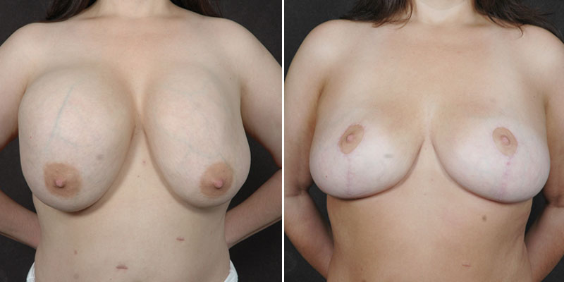 Dr. Kao Breast Implant Revision