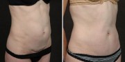 Dr. Kao Tummy Tuck (Abdominoplasty)