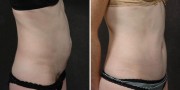 Dr. Kao Tummy Tuck (Abdominoplasty)