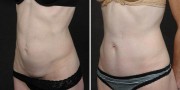 Dr. Kao Tummy Tuck (Abdominoplasty)