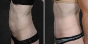 Dr. Kao Tummy Tuck (Abdominoplasty)