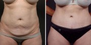 Dr. Kao Tummy Tuck (Abdominoplasty)