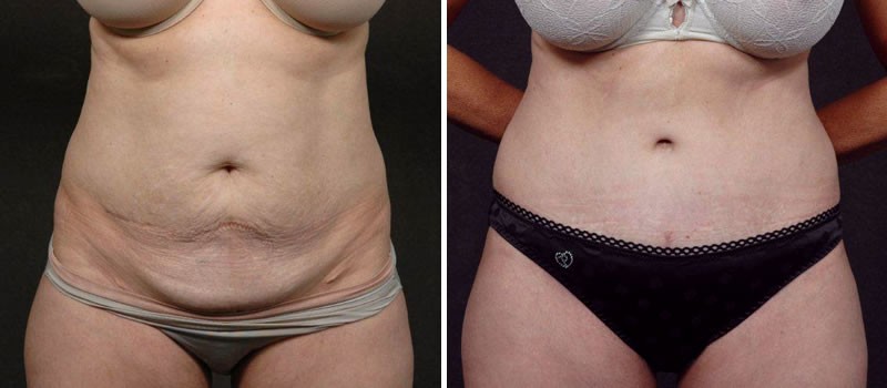 Dr. Kao Tummy Tuck (Abdominoplasty)