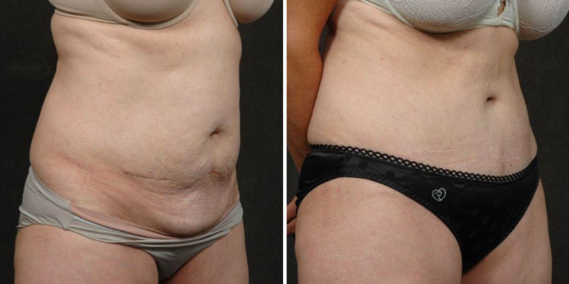 Dr. Kao Tummy Tuck (Abdominoplasty)