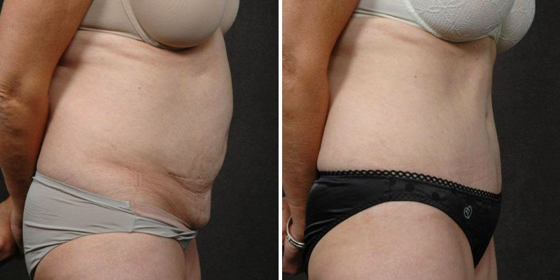 Dr. Kao Tummy Tuck (Abdominoplasty)