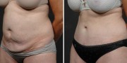 Dr. Kao Tummy Tuck (Abdominoplasty)