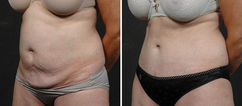 Dr. Kao Tummy Tuck (Abdominoplasty)