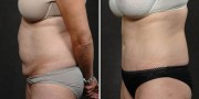 Dr. Kao Tummy Tuck (Abdominoplasty)