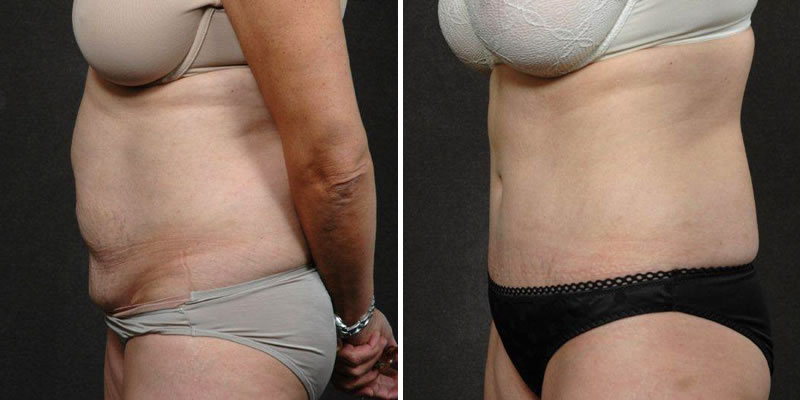 Dr. Kao Tummy Tuck (Abdominoplasty)