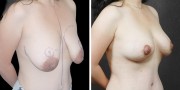 Dr. Kao Internal Bra Breast Lift (Mastopexy)