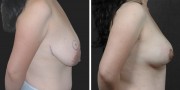 Dr. Kao Internal Bra Breast Lift (Mastopexy)