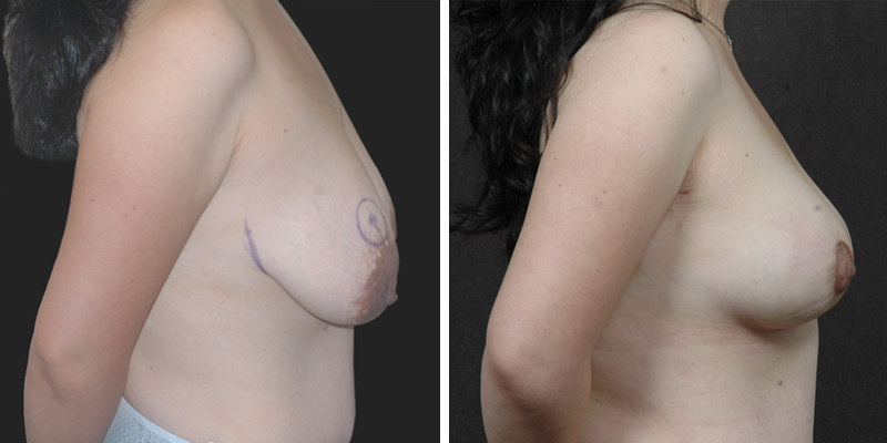 Dr. Kao Internal Bra Breast Lift (Mastopexy)