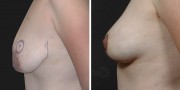 Dr. Kao Internal Bra Breast Lift (Mastopexy)